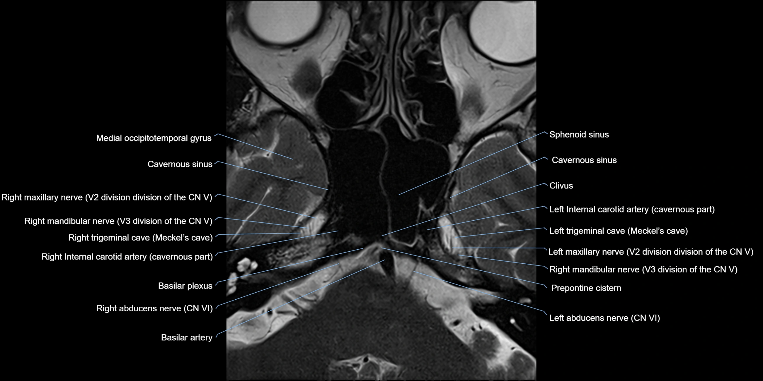 MRI cavernous sinus axial cross sectional 3T anatomy image-img-11001-00005.webp